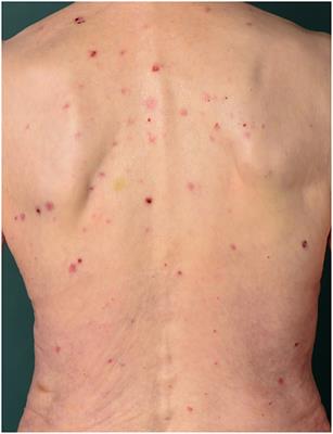 Pruritus